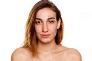 young woman with problematic skin and without makeup poses on a white background