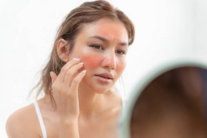 Gruaja e re është e shqetësuar për fytyrat Dermatologjike dhe alergjike ndaj steroideve në kozmetikë.lëkurë të ndjeshme, fytyrë të skuqur nga djegia nga dielli, puçrra fytyre, alergjike ndaj kimikateve, skuqje në fytyrë.problemet e lëkurës dhe bukuria
